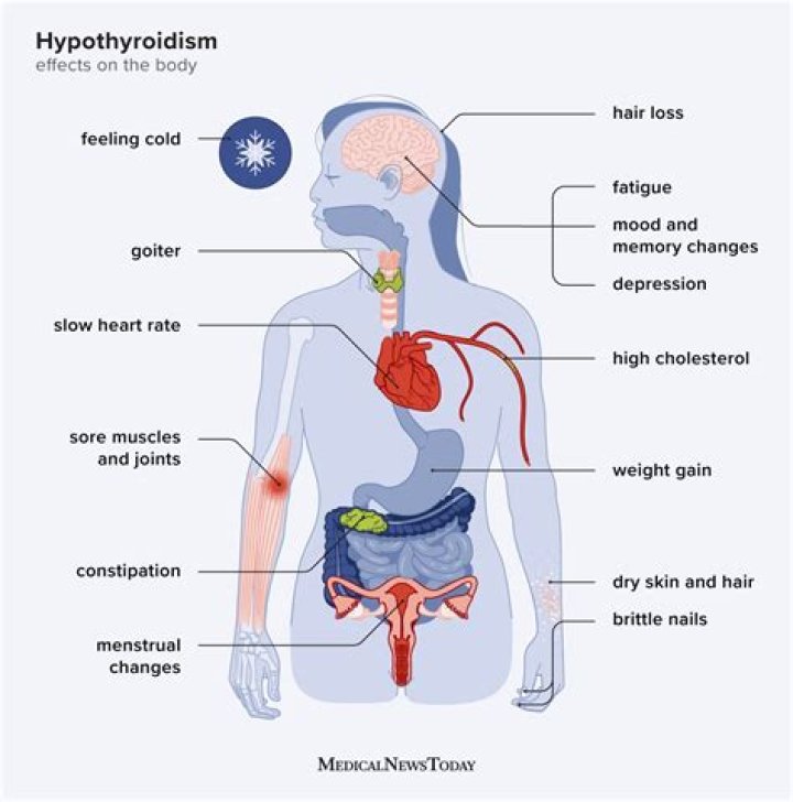How do you treat muscle pain with hypothyroidism?