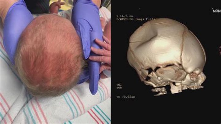 How is the skull put back together after surgery?