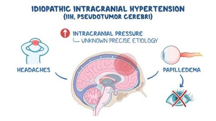 Is intracranial hypertension life threatening?
